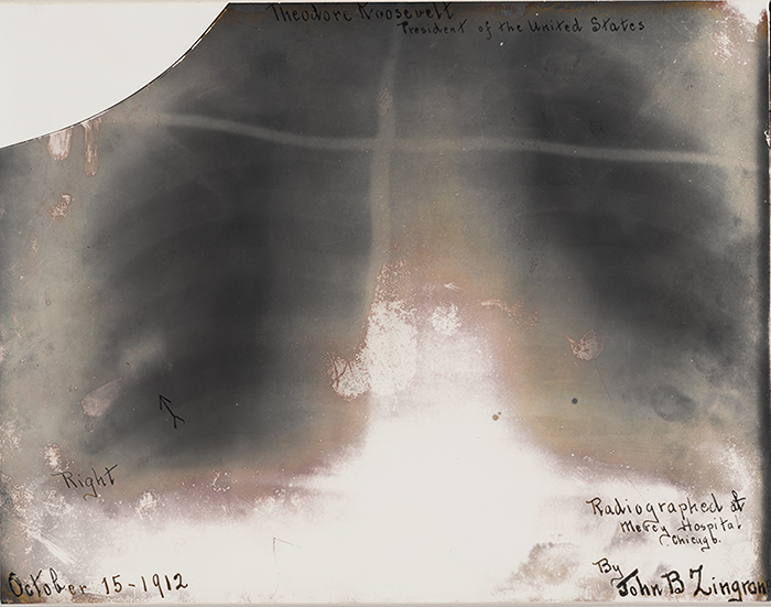 Roosevelt's chest X-ray, showing the bullet in the right lung