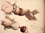 Plate 9. Illustrations of the Great Operations of Surgery by Charles Bell. Via Wellcome Collection.