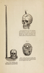 J. M. Harlow, "Recovery from the Passage of an Iron Bar Through the Head," 1869. Via the National Library of Medicine.